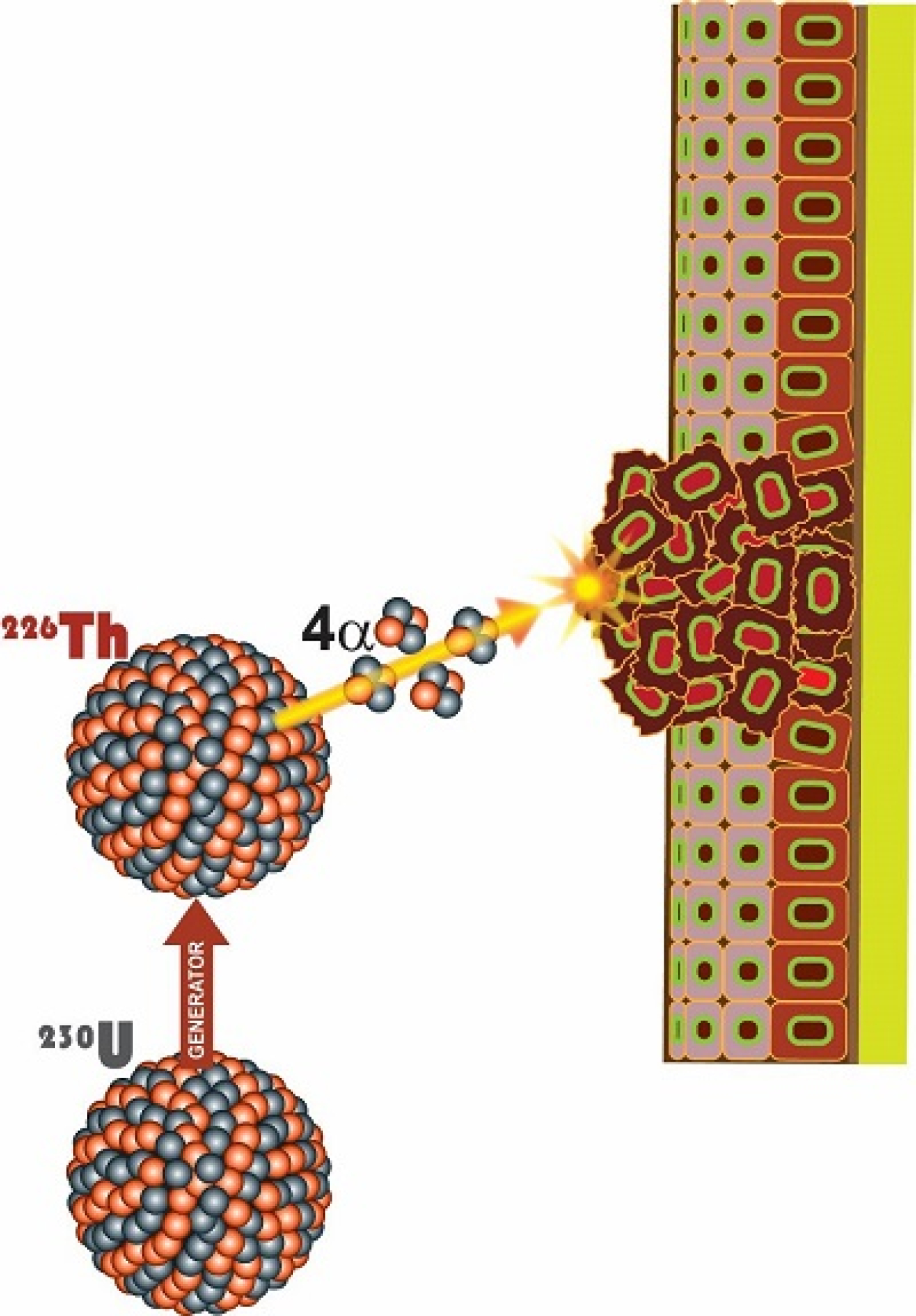 Alpha particle bombarded cancer tissue: a generator holds uranium-230 to produce thorium-226; further decay to short-lived daughters emits four more alpha particles resulting in a very high combined radiation dose delivered to cancer cells. 